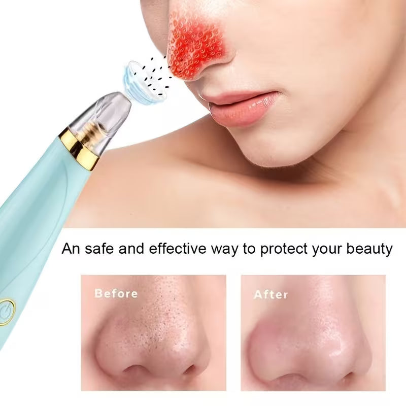 Blackhead Remover Pore Vacuum – Battery-Powered Deep Pore Cleaner