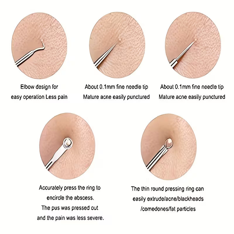 4pcs Blackhead Remover Tool Kit – Comedone Extractor Set