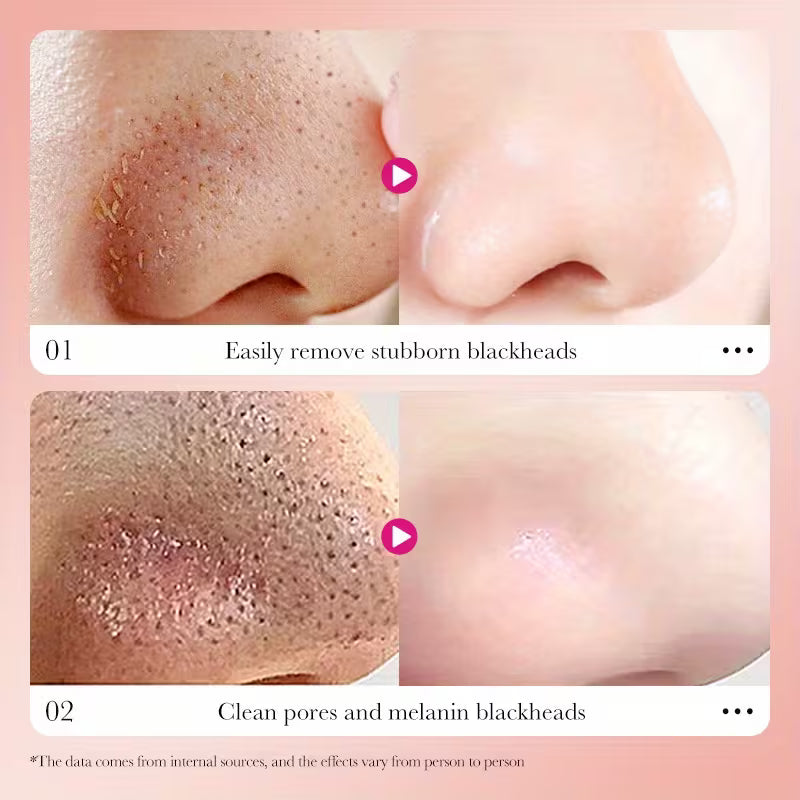 Bamboo Charcoal Deep Cleansing Nose Strips – Blackhead & Whitehead Remover